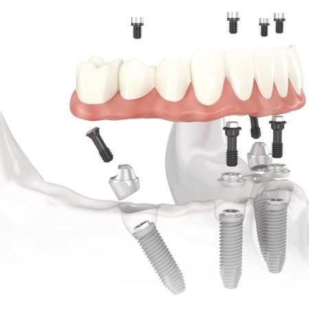 All-on-4-all-on-6-implant-1